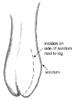 Diagram showing the location of one possible incision